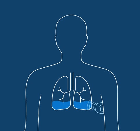 Illustration of pulmonary fluid measured by radar waves emitting from ZOLL Heart Failure Management System (HFMS) patch