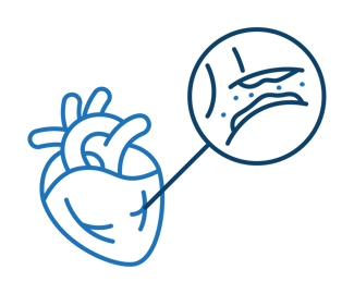 Human heart illustration and a blockage icon depicting a heart attack