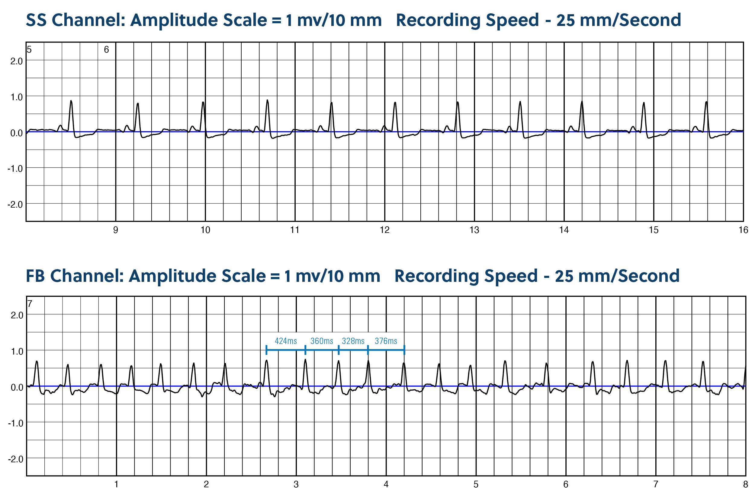 ZPM Trends Chart for Atrial Fibrillation