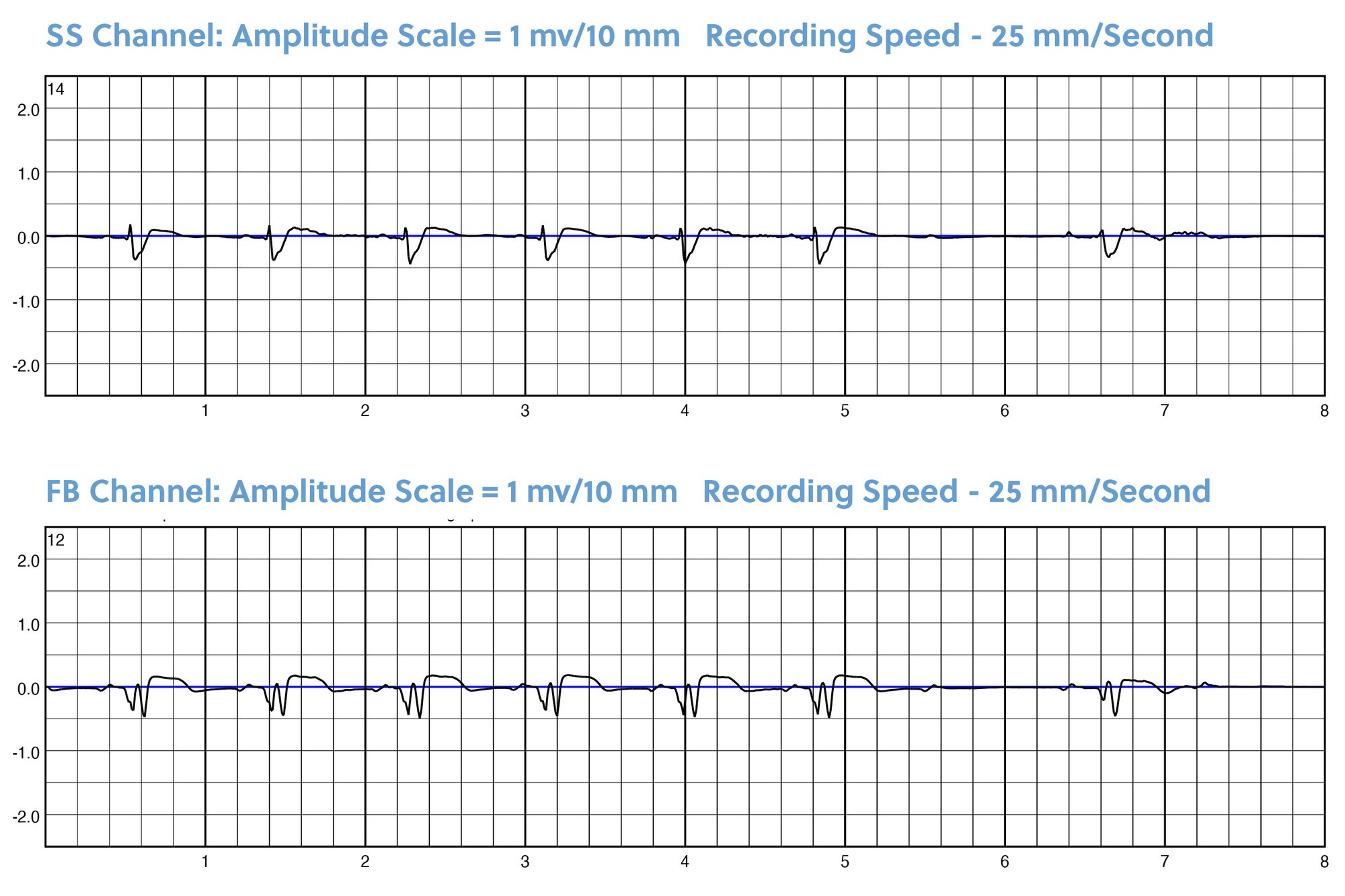 ZPM Trends Charts for Bradycardia