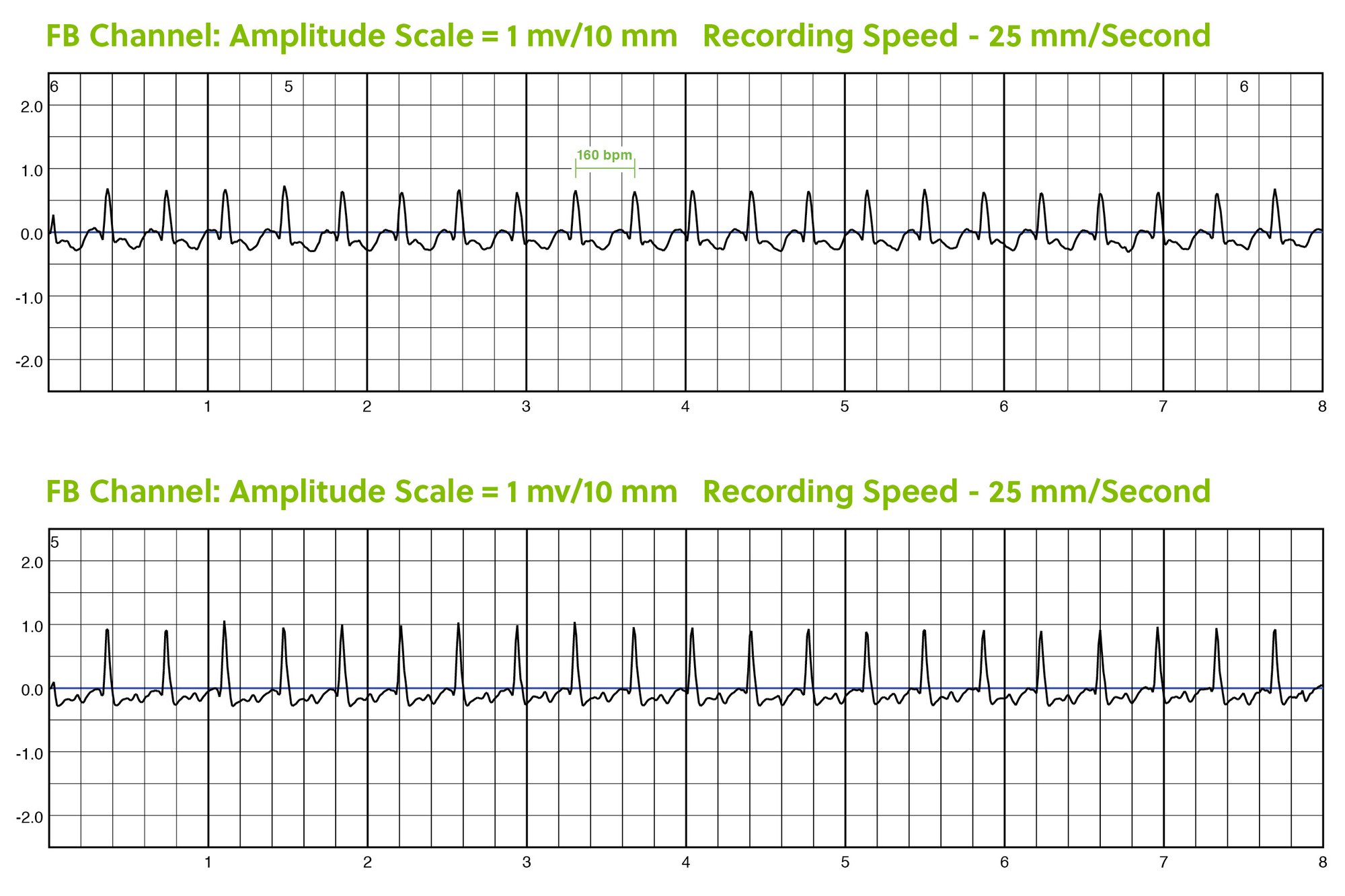 ZPM Trends Charts for Sinus Tachycardia