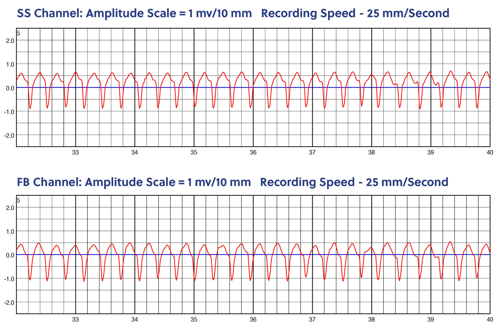 ZPM Trends Charts for Sustained VT